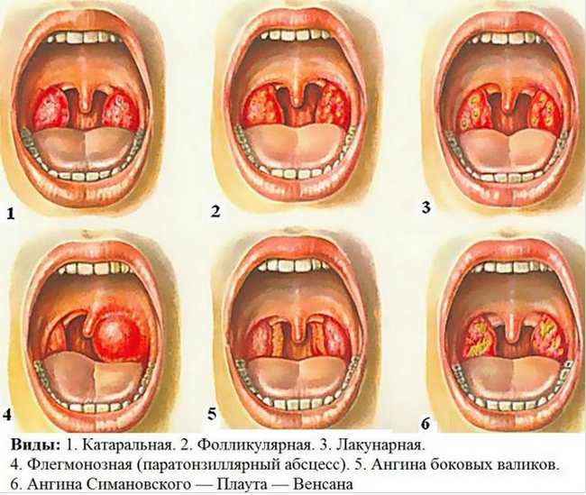 Формы ангины