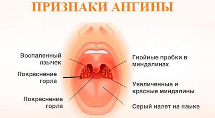 Признаки ангины